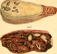 An illustration from Illustrations of pulmonary consumption : its anatomical characters, causes, symptoms and treatment. With twelve plates, drawn and coloured from nature / By Samuel George Morton. (1834)