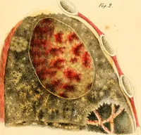 An illustration from Illustrations of pulmonary consumption : its anatomical characters, causes, symptoms and treatment. With twelve plates, drawn and coloured from nature / By Samuel George Morton. (1834)