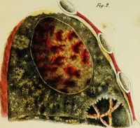 An illustration from Illustrations of pulmonary consumption : its anatomical characters, causes, symptoms and treatment. With twelve plates, drawn and coloured from nature / By Samuel George Morton. (1834)