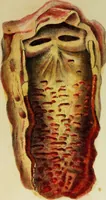 An illustration from Illustrations of pulmonary consumption : its anatomical characters, causes, symptoms and treatment. With twelve plates, drawn and coloured from nature / By Samuel George Morton. (1834)