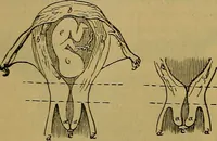An illustration from The origin of life and process of reproduction in plants and animals : with the anatomy and physiology of the human generative system, male and female, and the causes, prevention and cure of the special diseases to which it is liable : a plain, practical treatise, for popular use / by Dr. F. Hollick ; illustrated by engravings and colored plates. (1902)