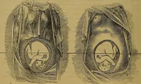 Picture 142 of 163 from The origin of life and process of reproduction in plants and animals : with the anatomy and physiology of the human generative system, male and female, and the causes, prevention and cure of the special diseases to which it is liable : a plain, practical treatise, for popular use / by Dr. F. Hollick ; illustrated by engravings and colored plates. (1902), leaf 886