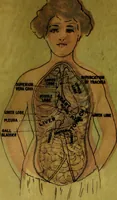 An illustration from Tuberculosis and allied diseases : an account of their origin and treatment from the earliest times up to and including the present / by Freeman Hall .. (1912)