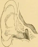 Picture 15 of 45 from Diseases of the ear : a text-book for practitioners and students of medicine / by Edward Bradford Dench. (1900), leaf 111