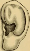 Picture 33 of 45 from Diseases of the ear : a text-book for practitioners and students of medicine / by Edward Bradford Dench. (1900), leaf 240