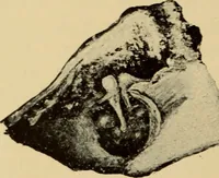 Picture 6 of 45 from Diseases of the ear : a text-book for practitioners and students of medicine / by Edward Bradford Dench. (1900), leaf 44