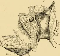 An illustration from Diseases of the ear : a text-book for practitioners and students of medicine / by Edward Bradford Dench. (1900)