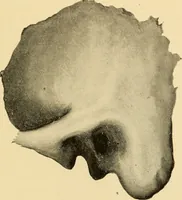 An illustration from Diseases of the ear : a text-book for practitioners and students of medicine / by Edward Bradford Dench. (1900)