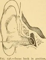 An illustration from Diseases of the ear : a text-book for practitioners and students of medicine / by Edward Bradford Dench. (1900)