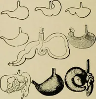 An illustration from Diseases of infants and children / by Henry Dwight Chapin and Godfrey Roger Pisek ; with 181 ill. and eleven colored plates. (1911)