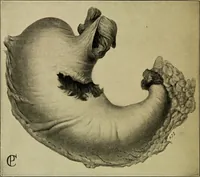 Picture 37 of 64 from Diseases of infants and children / by Henry Dwight Chapin and Godfrey Roger Pisek ; with 181 ill. and eleven colored plates. (1911), leaf 244