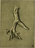 An illustration from Diseases of infants and children / by Henry Dwight Chapin and Godfrey Roger Pisek ; with 181 ill. and eleven colored plates. (1911)