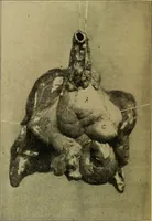 An illustration from Diseases of infants and children / by Henry Dwight Chapin and Godfrey Roger Pisek ; with 181 ill. and eleven colored plates. (1911)