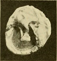 An illustration from A manual of otology / By Gorham Bacon ... With an introductory chapter by Clarence John Blake ... With 110 illustrations and a colored plate. (1898)