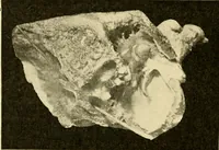An illustration from A manual of otology / By Gorham Bacon ... With an introductory chapter by Clarence John Blake ... With 110 illustrations and a colored plate. (1898)