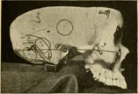 An illustration from A manual of otology / By Gorham Bacon ... With an introductory chapter by Clarence John Blake ... With 110 illustrations and a colored plate. (1898)