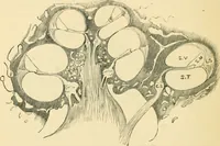 An illustration from A manual of otology / By Gorham Bacon ... With an introductory chapter by Clarence John Blake ... With 110 illustrations and a colored plate. (1898)