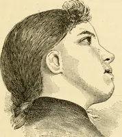 An illustration from A manual of otology / By Gorham Bacon ... With an introductory chapter by Clarence John Blake ... With 110 illustrations and a colored plate. (1898)