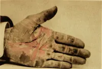 An illustration from Photographic illustrations of skin diseases : Forty-eight plates from life. Colored by hand / by George Henry Fox. (1880)