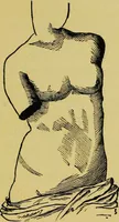 An illustration from Ladies' guide in health and disease : girlhood, maidenhood, wifehood, motherhood / by J.H. Kellogg. (1892)