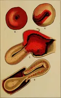 An illustration from Ladies' guide in health and disease : girlhood, maidenhood, wifehood, motherhood / by J.H. Kellogg. (1892)