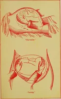An illustration from Ladies' guide in health and disease : girlhood, maidenhood, wifehood, motherhood / by J.H. Kellogg. (1892)