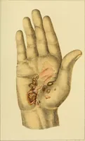 An illustration from Syphilis : its nature & diffusion popularly considered / by James George Beaney ... With fifteen coloured plates. (1869)