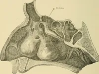 An illustration from Diseases of the nose and throat / by J. Price-Brown ; ill. with 159 engravings, including 6 full-page color-plates and 9 color-cuts in the text, many of them original. (1900)