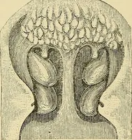 An illustration from Diseases of the nose and throat / by J. Price-Brown ; ill. with 159 engravings, including 6 full-page color-plates and 9 color-cuts in the text, many of them original. (1900)