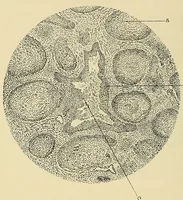An illustration from Diseases of the nose and throat / by J. Price-Brown ; ill. with 159 engravings, including 6 full-page color-plates and 9 color-cuts in the text, many of them original. (1900)