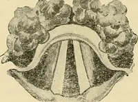 An illustration from Diseases of the nose and throat / by J. Price-Brown ; ill. with 159 engravings, including 6 full-page color-plates and 9 color-cuts in the text, many of them original. (1900)