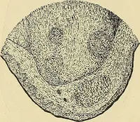 An illustration from Diseases of the nose and throat / by J. Price-Brown ; ill. with 159 engravings, including 6 full-page color-plates and 9 color-cuts in the text, many of them original. (1900)
