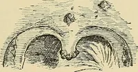 An illustration from Diseases of the nose and throat / by J. Price-Brown ; ill. with 159 engravings, including 6 full-page color-plates and 9 color-cuts in the text, many of them original. (1900)