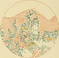 An illustration from Diseases of the nose and throat / by J. Price-Brown ; ill. with 159 engravings, including 6 full-page color-plates and 9 color-cuts in the text, many of them original. (1900)