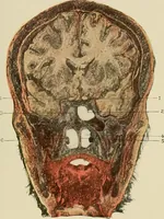 An illustration from Diseases of the nose and throat / by J. Price-Brown ; ill. with 159 engravings, including 6 full-page color-plates and 9 color-cuts in the text, many of them original. (1900)