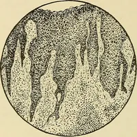An illustration from Diseases of the nose and throat / by J. Price-Brown ; ill. with 159 engravings, including 6 full-page color-plates and 9 color-cuts in the text, many of them original. (1900)