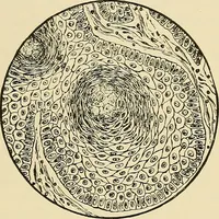 An illustration from Diseases of the nose and throat / by J. Price-Brown ; ill. with 159 engravings, including 6 full-page color-plates and 9 color-cuts in the text, many of them original. (1900)