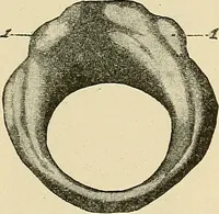 An illustration from Diseases of the nose and throat / by J. Price-Brown ; ill. with 159 engravings, including 6 full-page color-plates and 9 color-cuts in the text, many of them original. (1900)