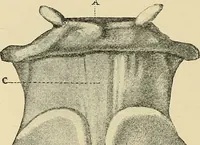 An illustration from Diseases of the nose and throat / by J. Price-Brown ; ill. with 159 engravings, including 6 full-page color-plates and 9 color-cuts in the text, many of them original. (1900)