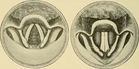 An illustration from Diseases of the nose and throat / by J. Price-Brown ; ill. with 159 engravings, including 6 full-page color-plates and 9 color-cuts in the text, many of them original. (1900)