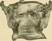 An illustration from Diseases of the nose and throat / by J. Price-Brown ; ill. with 159 engravings, including 6 full-page color-plates and 9 color-cuts in the text, many of them original. (1900)