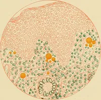 An illustration from Diseases of the nose and throat / by J. Price-Brown ; ill. with 159 engravings, including 6 full-page color-plates and 9 color-cuts in the text, many of them original. (1900)