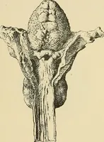 An illustration from Diseases of the nose and throat / by J. Price-Brown ; ill. with 159 engravings, including 6 full-page color-plates and 9 color-cuts in the text, many of them original. (1900)
