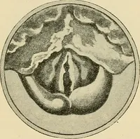 An illustration from Diseases of the nose and throat / by J. Price-Brown ; ill. with 159 engravings, including 6 full-page color-plates and 9 color-cuts in the text, many of them original. (1900)