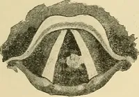 An illustration from Diseases of the nose and throat / by J. Price-Brown ; ill. with 159 engravings, including 6 full-page color-plates and 9 color-cuts in the text, many of them original. (1900)
