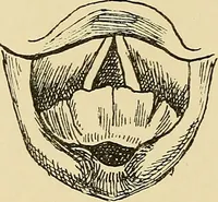 An illustration from Diseases of the nose and throat / by J. Price-Brown ; ill. with 159 engravings, including 6 full-page color-plates and 9 color-cuts in the text, many of them original. (1900)