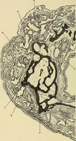 An illustration from Diseases of the nose and throat / by J. Price-Brown ; ill. with 159 engravings, including 6 full-page color-plates and 9 color-cuts in the text, many of them original. (1900)