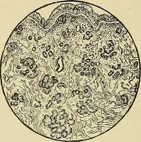 An illustration from Diseases of the nose and throat / by J. Price-Brown ; ill. with 159 engravings, including 6 full-page color-plates and 9 color-cuts in the text, many of them original. (1900)