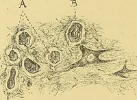 An illustration from Contribution à l'étude de l'atrophie musculaire progressive, type Duchenne-Aran / par le Dr. J. -B. Charcot. (1895)