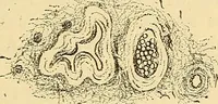 An illustration from Contribution à l'étude de l'atrophie musculaire progressive, type Duchenne-Aran / par le Dr. J. -B. Charcot. (1895)
